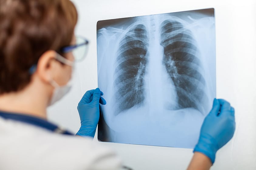 A doctor holding up an x-ray of a heroin patient’s lungs.