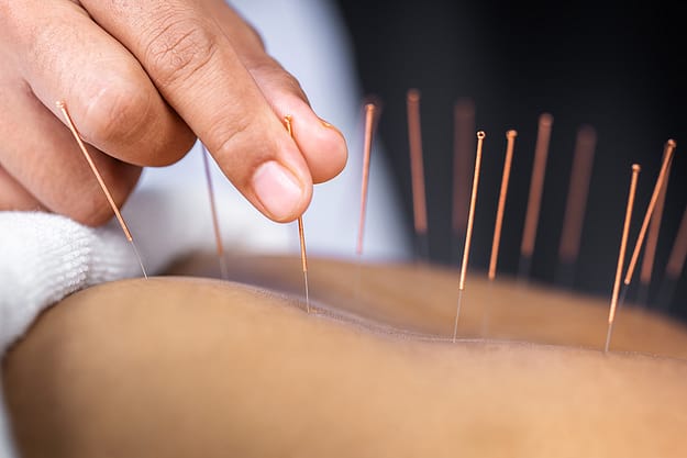 woman getting acupuncture receiving the benefits of acupuncture during addiction treatment